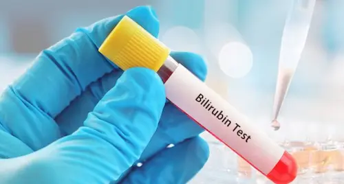 Bilirubin test image