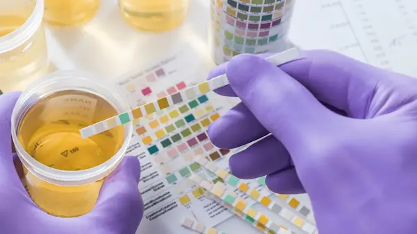 Urine Culture Test